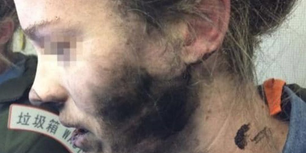 Wanita Australia dengan wajahnya terbakar oleh ledakan headphone Beats-nya